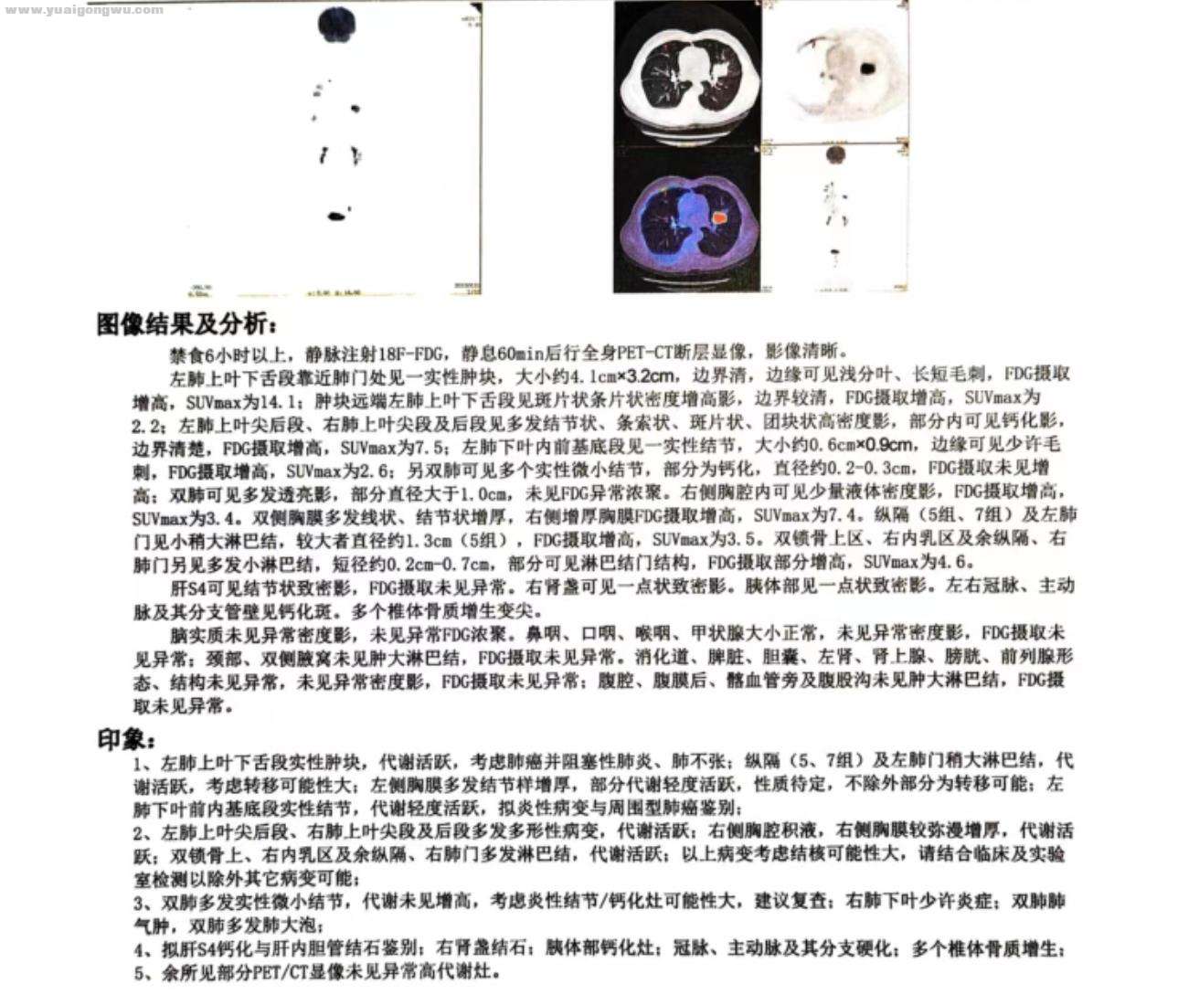 6月20日-petCT检查报告.jpg